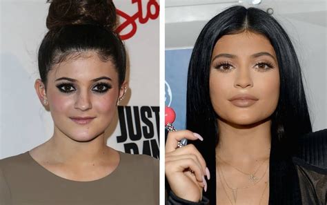 kylie jenner vorher nachher bilder|Kylie Jenner, Before and After